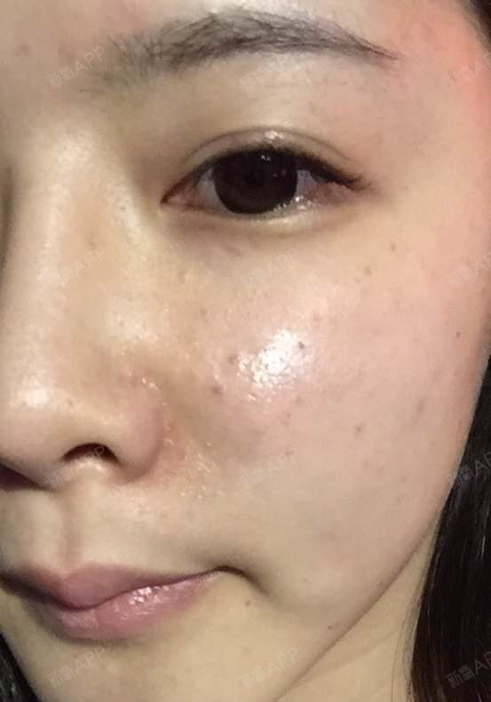 第三次打水光补水,几乎没什么针眼,第一次打淤青红点非_圈子-新氧美容