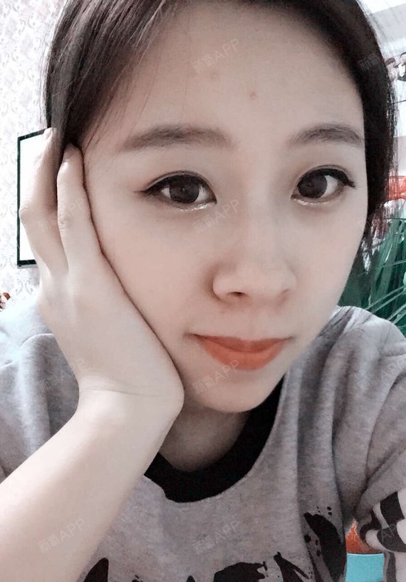 我想做鼻子 自己打算的是垫鼻尖缩鼻翼 鼻孔太圆很不喜欢 大家