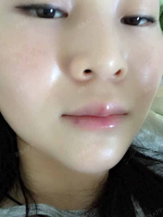 玻尿酸丰唇后第三天了嘴巴还是好痛.