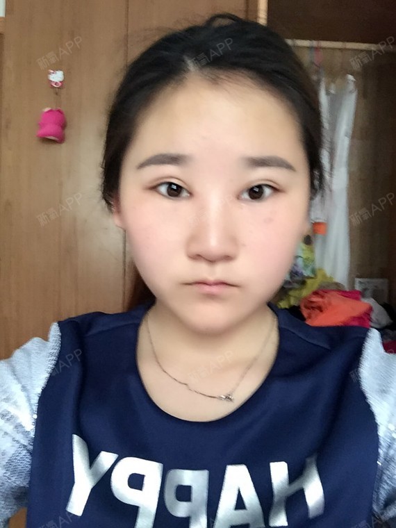 照片有点模糊,看现在的情况是双眼皮的线没挂在睑板上所以就造成这个