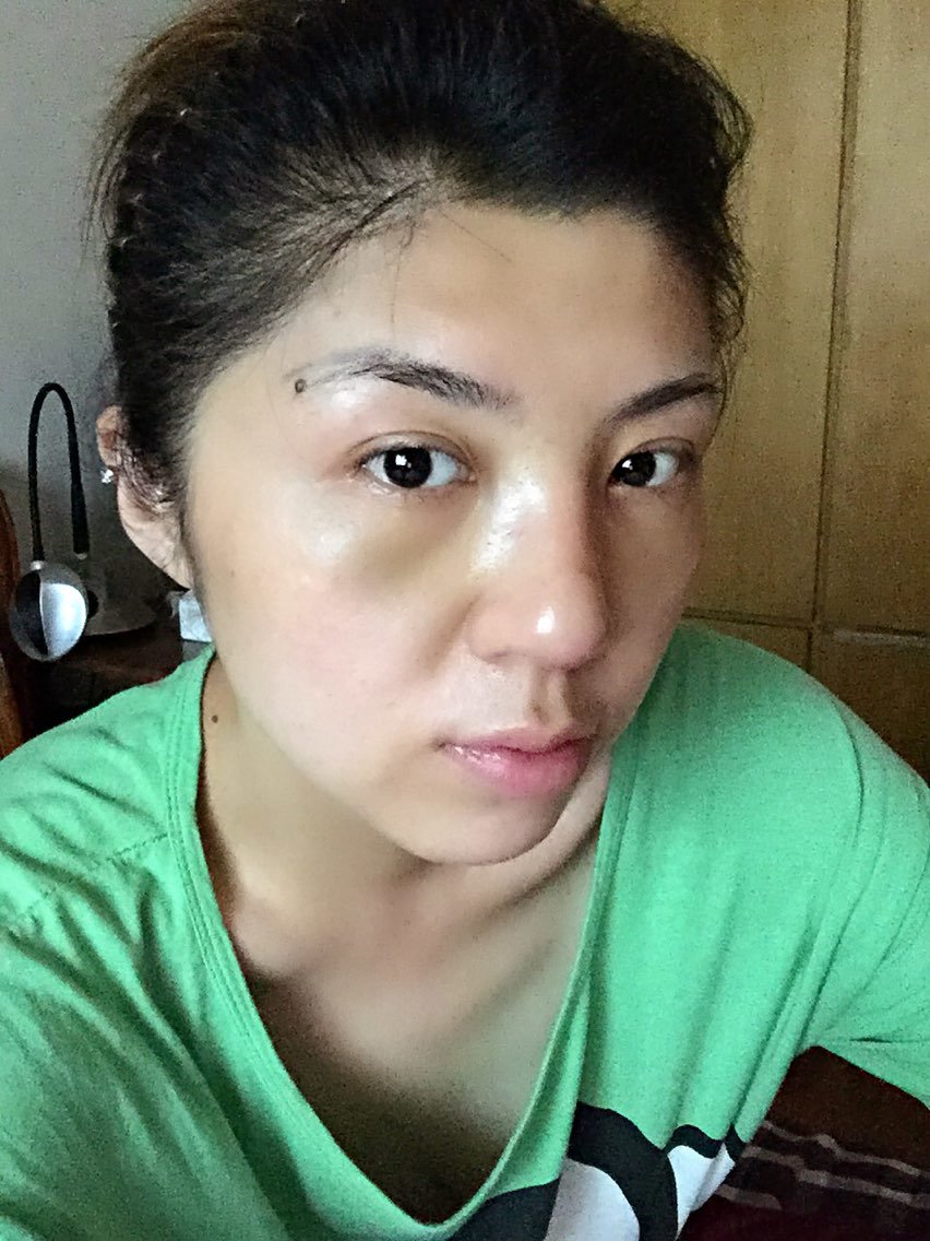 眼睛下面还是肿,面部也肿,开始发紫发黄了,加上隆鼻后鼻子也肿,肿得