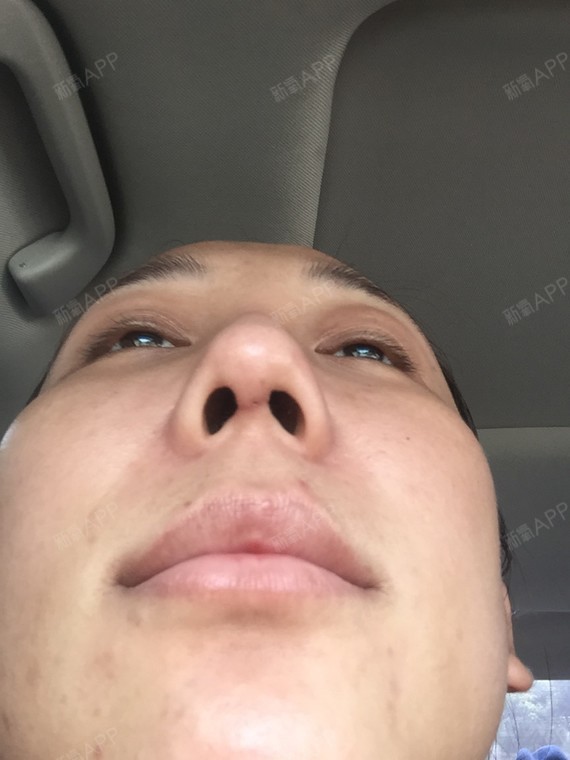 方案查看耳软骨复合隆鼻手术轻度疼痛隆鼻 			