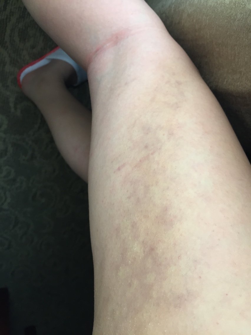快一个月了,腿围没有在变细了,只是大腿外侧特别硬.