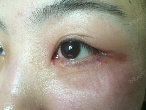 求助:这是伤口还是什么,今天拆纱布,左眼内眼角红红的痕迹,刚