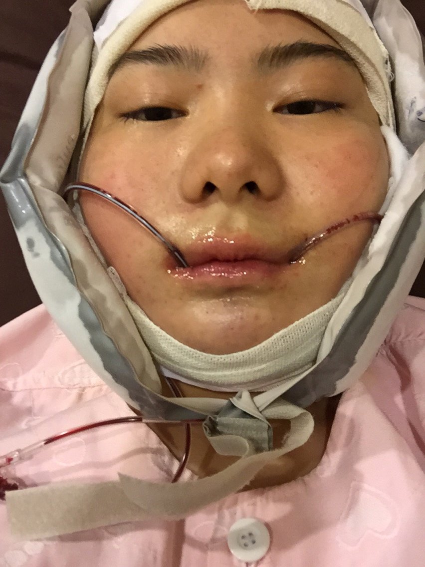 在faceplus做完颧骨跟vline手术了有点肿做完前院长说很好很欣慰呼几