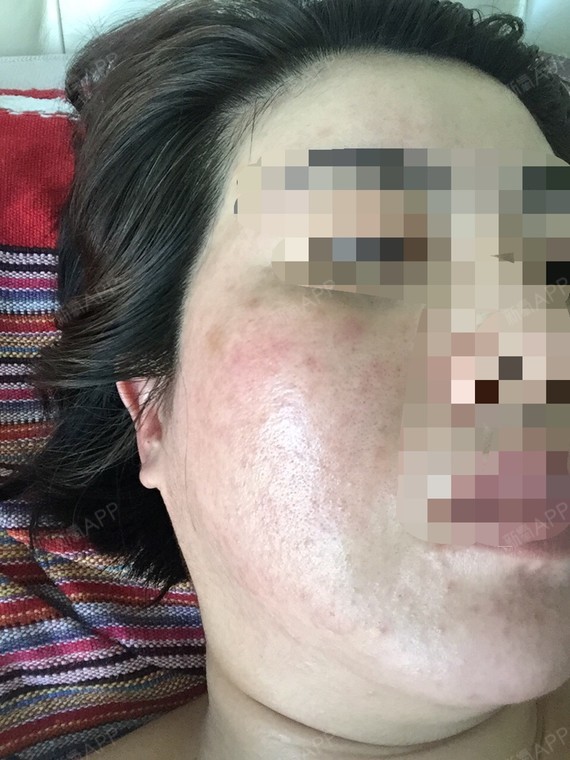 注射水光补水五天,面部红肿,有红疹,特别痒,还有很多_圈子-新氧美容