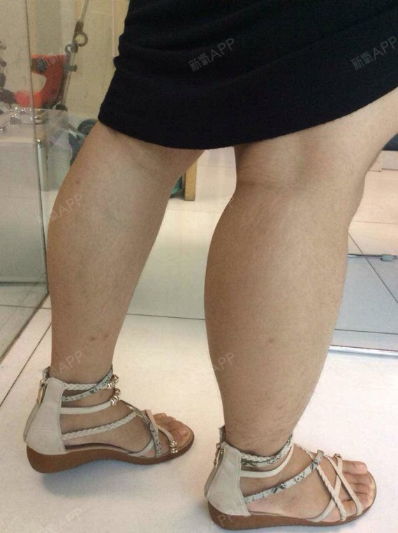 yayuanqiuyin肉毒素瘦小腿第0天美丽日记