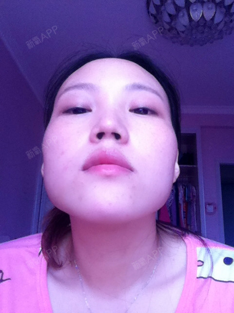 下颌角削骨_下颌角削骨有后遗症吗_下颌角削骨全过程