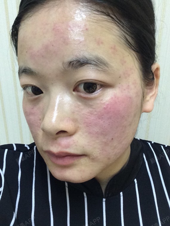 在深圳的米兰柏羽打的水光补水,打完感觉脸部发痒,具体_圈子-新氧美容