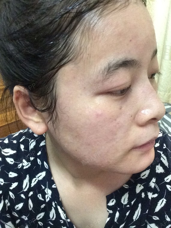 水光补水第二天,比昨天好一点儿,没有那么红了,暂时还没有很大