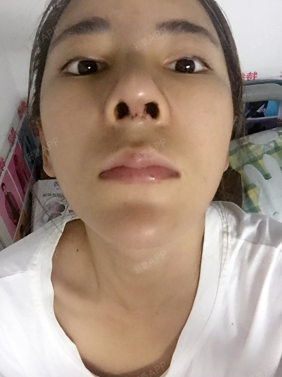 大家帮我看看,我自己感觉鼻根部有点宽,有点高,有一_圈子-新氧美容