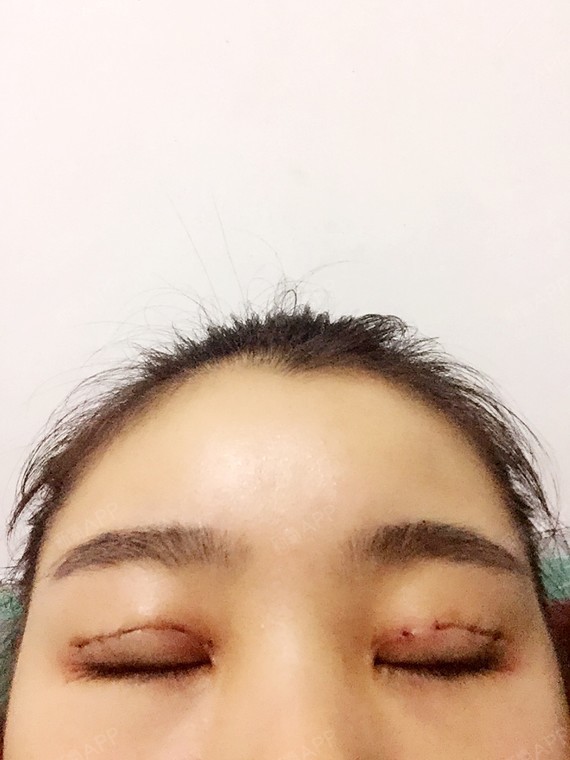 定点双眼皮好不好_效果图_帆帆帆帆帆帆定点双眼皮术后第3天_新氧美容