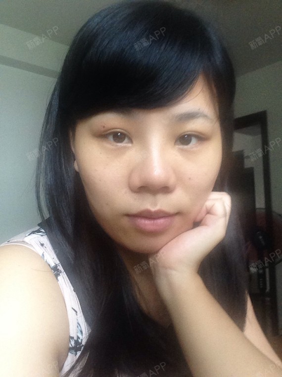 鼻头这样正常吗一个月了鼻头还是很大