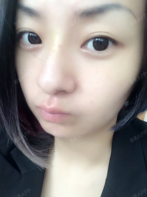 鼻梁中间有点淤青,针孔已经看不到啦,淤青消了就自然了