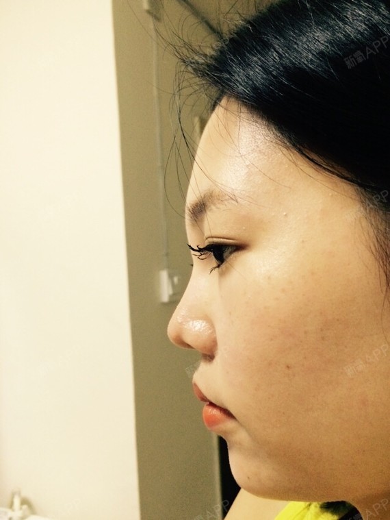 术前正侧面照片