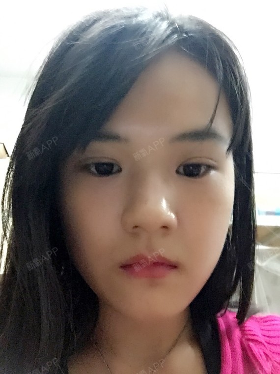 咬肌已经变软,相信慢慢变小的侧脸真的好大,今天要去_圈子-新氧美容