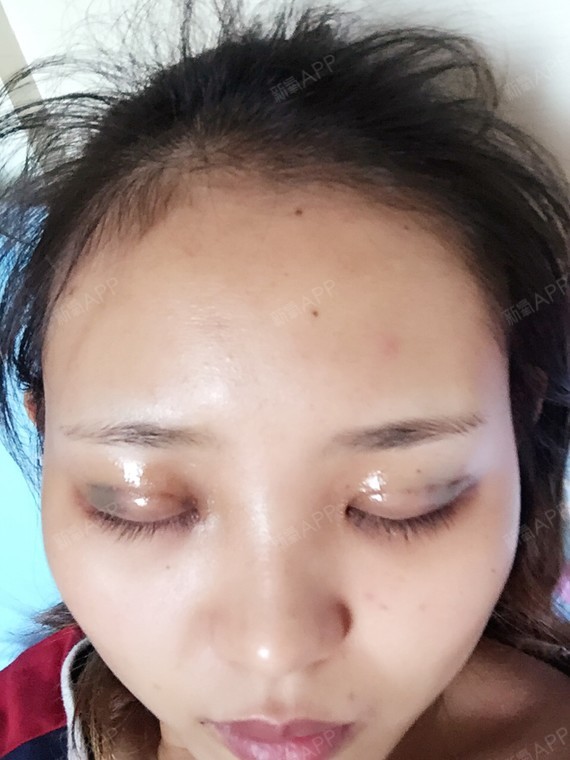 刚做完埋线 期待恢复