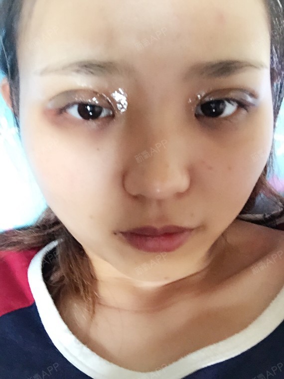 刚做完埋线期待恢复