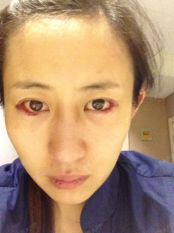 刚刚做完眼角下至外眼角痛死我了王医生做的不错