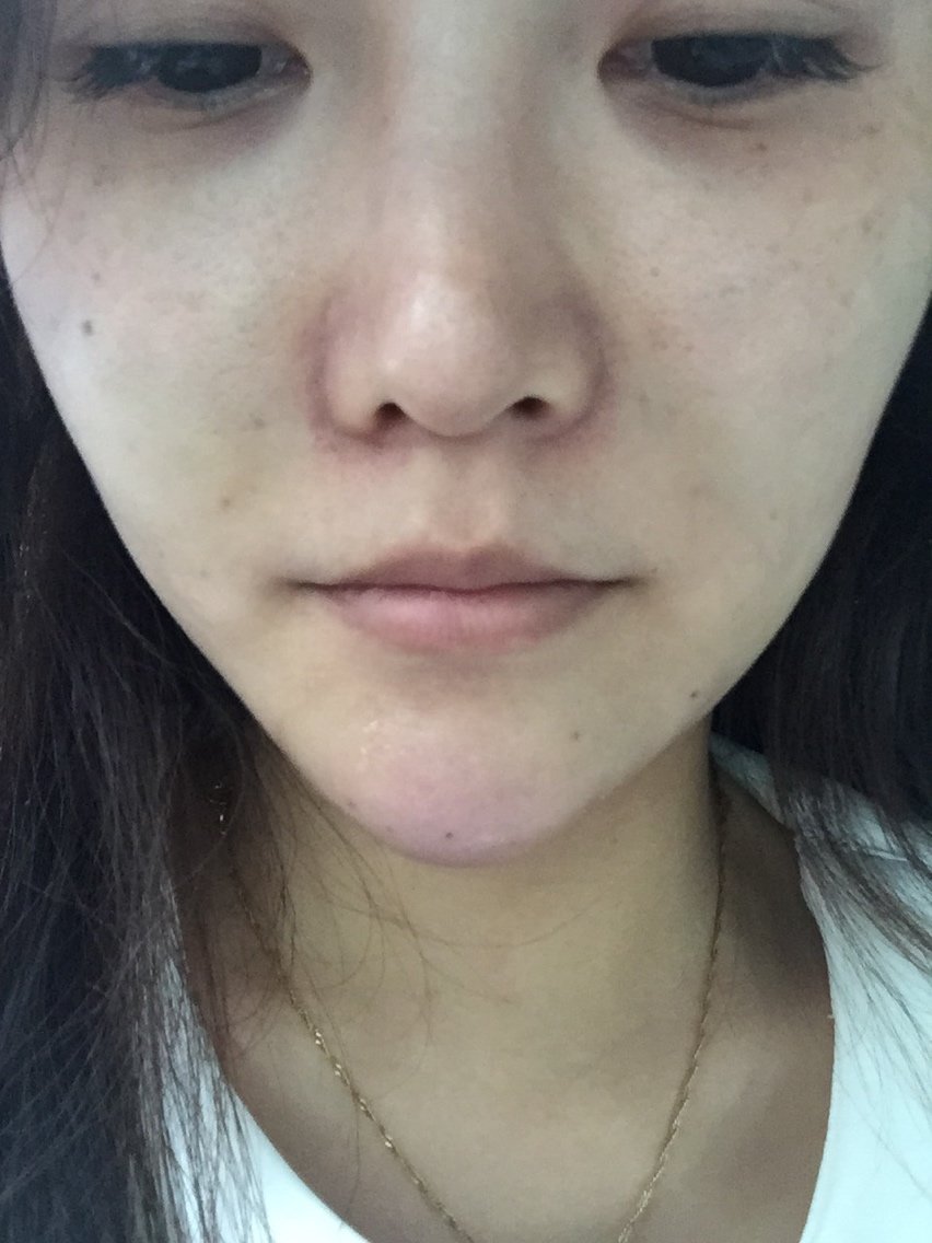 新氧- 小乔_863539 | 术后当自强 | 玻尿酸垫下巴 | 面部轮廓 | 下巴