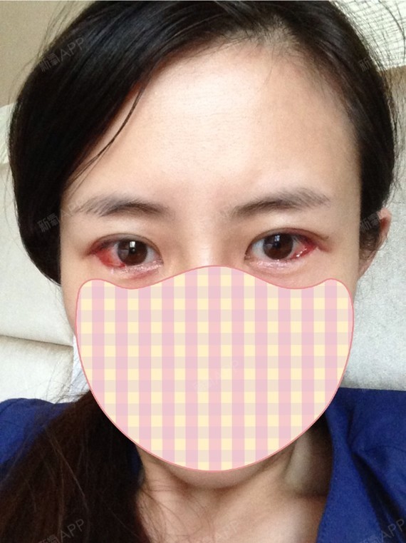 开外眼角好不好_效果图_lyt222开外眼角术后第2天_新氧美容整形