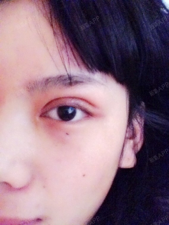 现在一个月了内眼角有增生双眼皮还是很肿