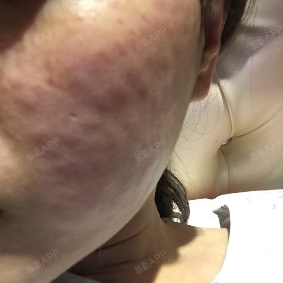 打完水光补水四天了.脸红肿.感觉过敏了.包下不去._圈子-新氧美容整形