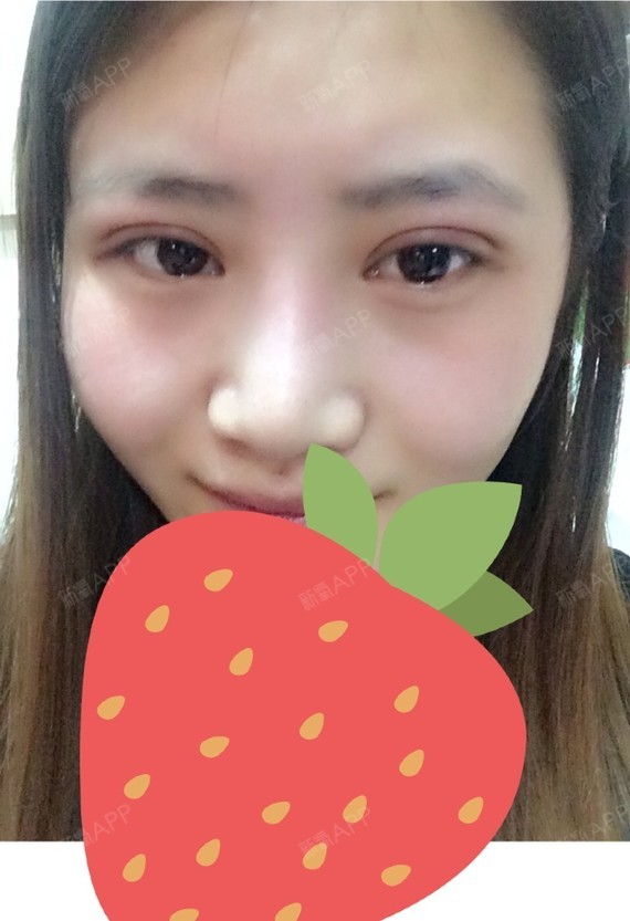 请问双眼皮做了两个月了 为什么还是肿肿的 是做坏了吗