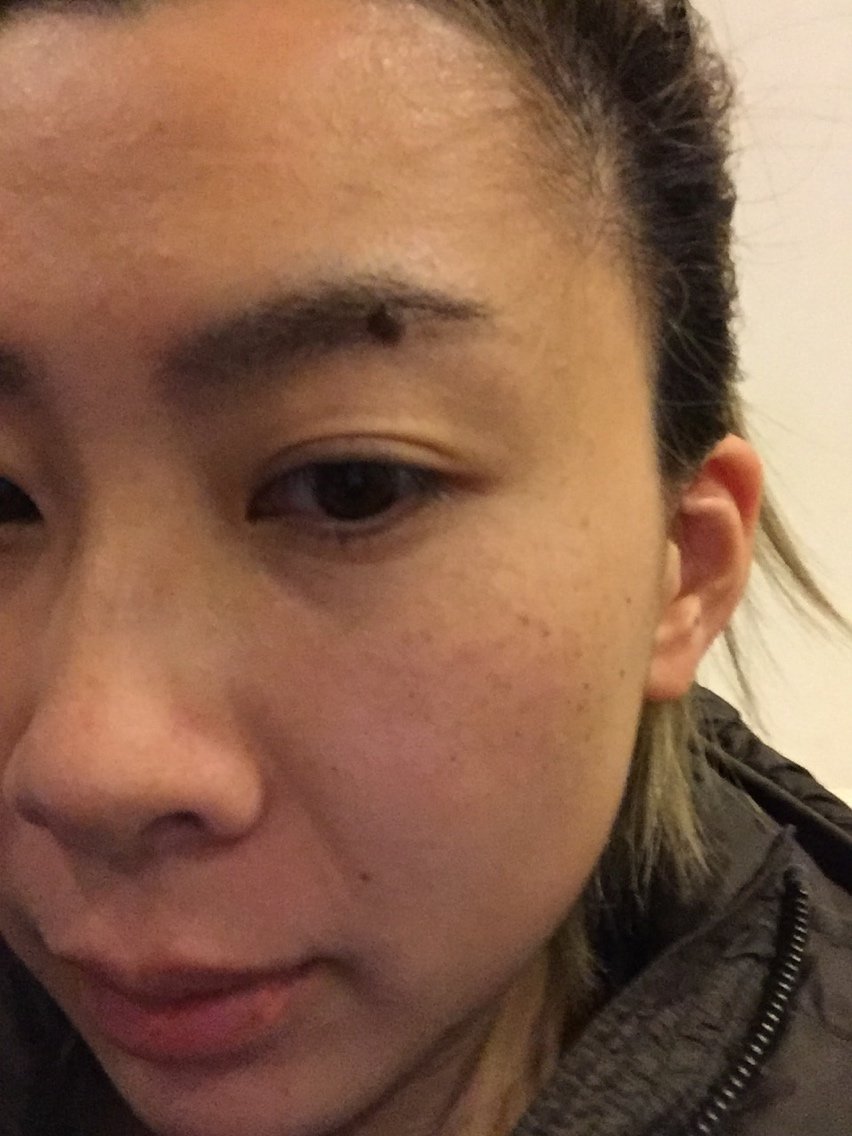 sherriiee激光祛斑第10天美丽日记-新氧美容整形