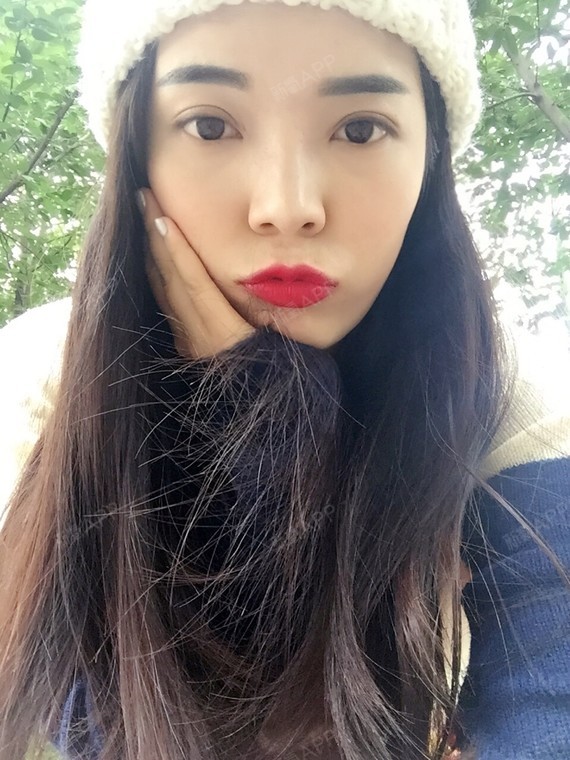 双眼皮第31天