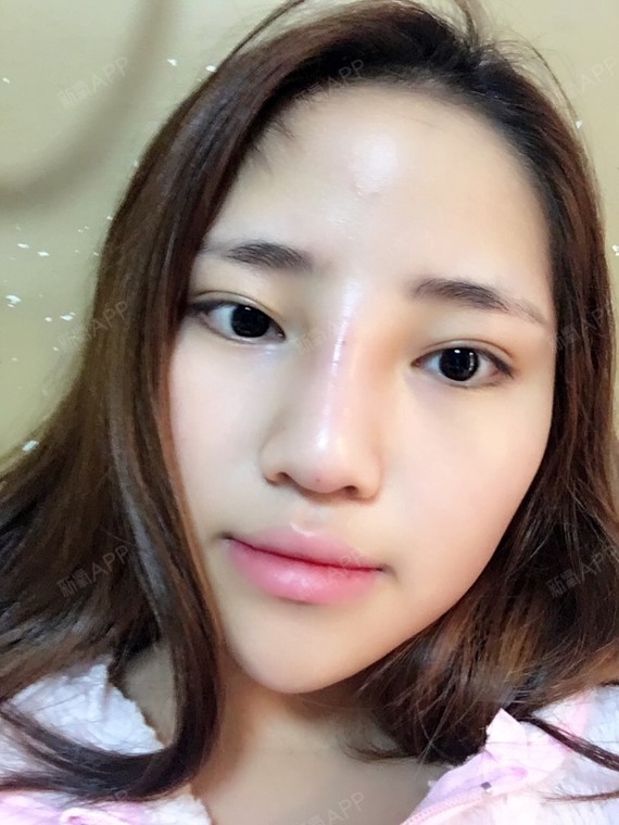 昨天打的玻尿酸.今天肿的太大了.最后一张没打之前