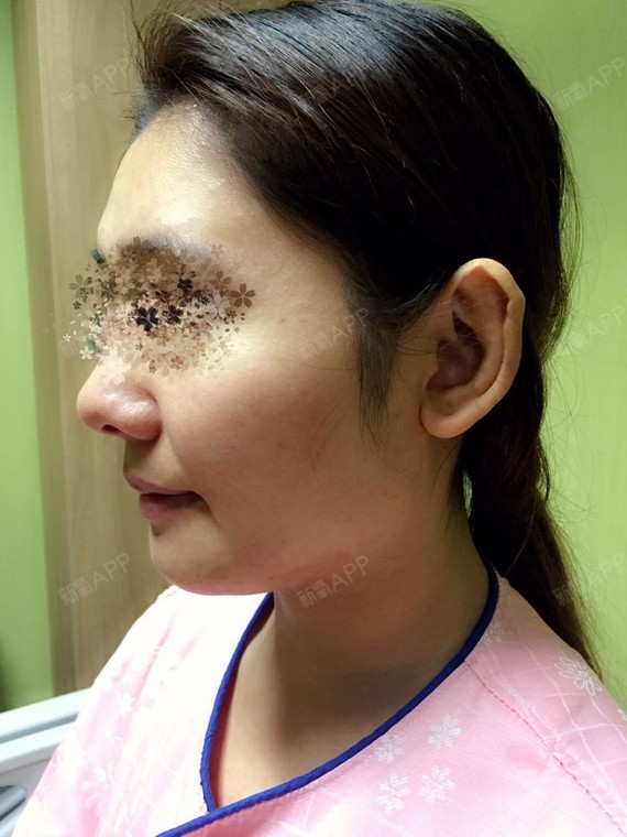 cici_125128颧骨内推第0天美丽日记