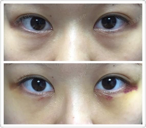 内切去眼袋好不好_效果图_mige内切去眼袋术后第7天_新氧美容整形