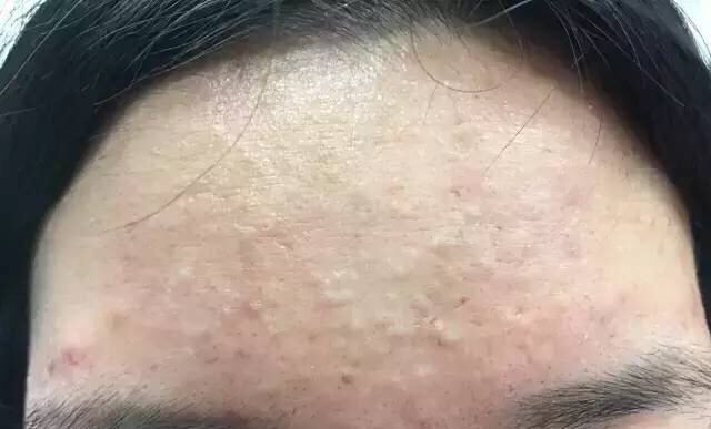 白头粉刺:角栓堵在毛囊口,皮脂排不出去.