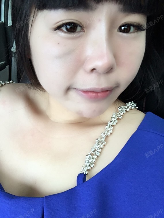 打了玻尿酸,居然把自己脸打出了淤青,现在医生自己承_圈子-新氧美容