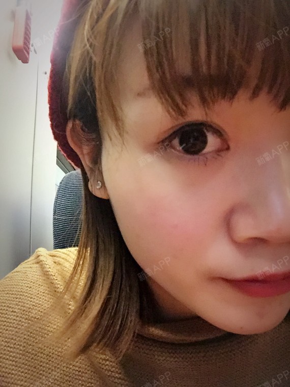 去年十月在北京美莱医院做的双眼皮加开眼角。