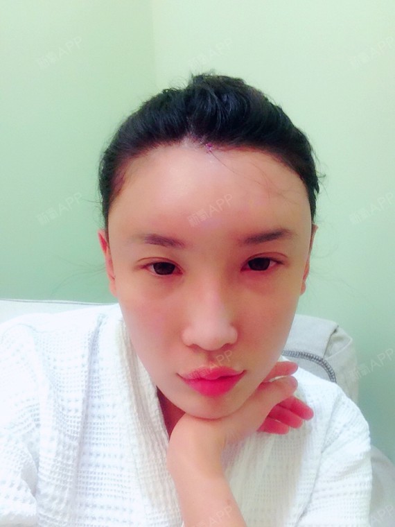 面部轮廓 | 额头 | 自体脂肪填充额头 | 术后当自强 | 国内整形