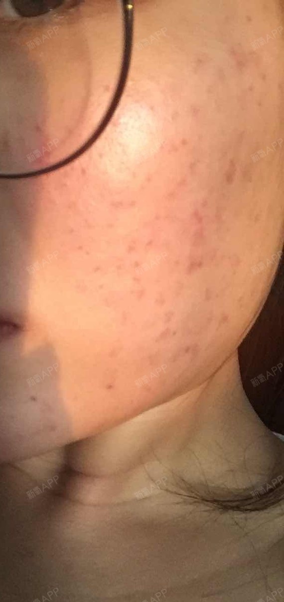 打了水光针已经3天了注射点还是满脸红印,_圈子-新氧美容整形