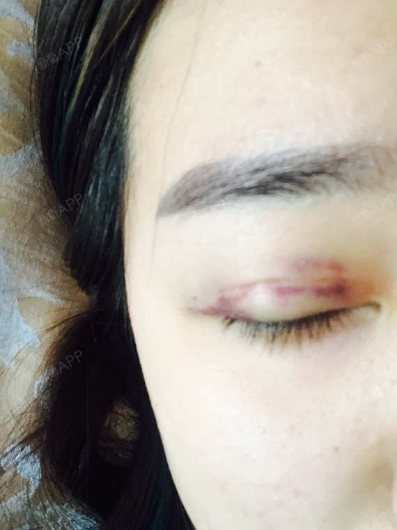 北京埋线双眼皮好不好_效果图_q_埋线双眼皮术后第2天_新氧美容整形