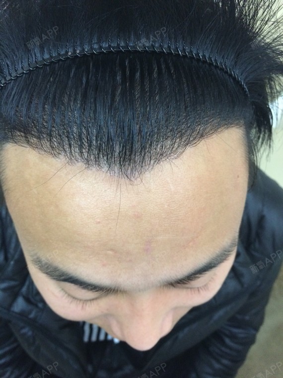 偶的发际线种植2000单位术后一年的植发效果本人觉_圈子-新氧美容整形