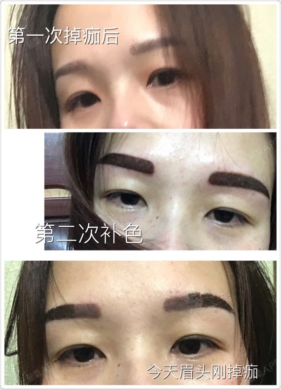 补色失败了,眉头掉完痂为嘛还这么深,说好的淡淡的呢.该怎么办