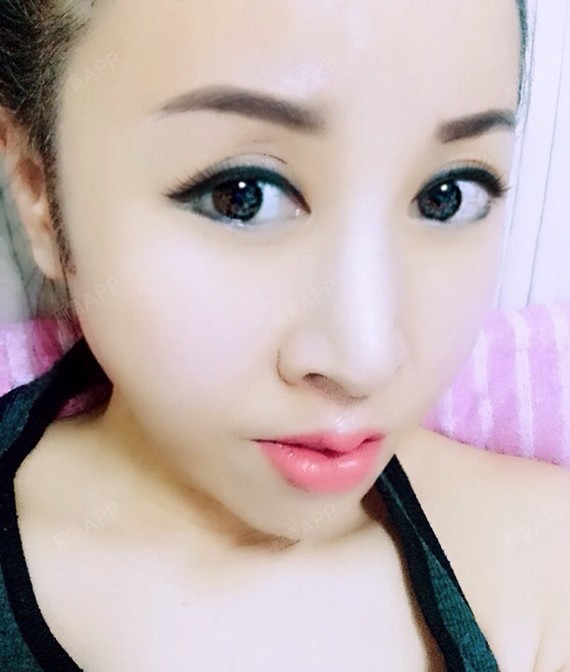 七世恋人自体脂肪丰唇第12天美丽日记