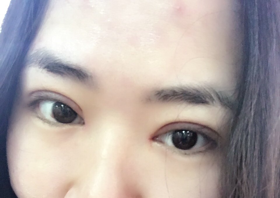 air_miss | 术后当自强 | 天津同城 | 开内眼角 | 眼部整形 | 开眼角