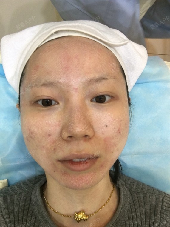 第一次飞梭完成,图15是刚做完,不疼,但是感觉脸热辣_圈子-新氧美容