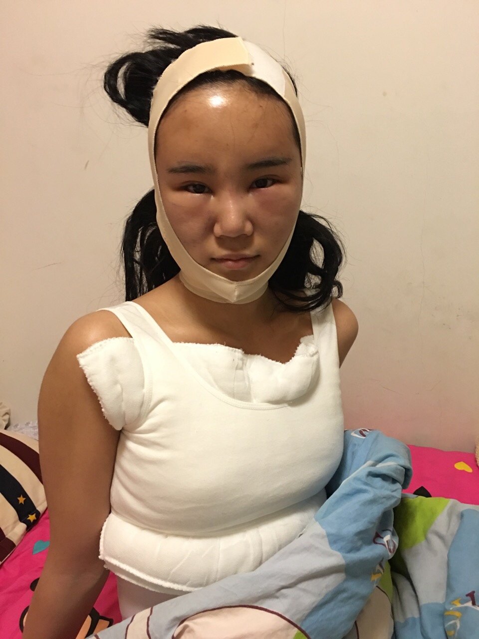 新氧 氧气4846649949949494 术后当自强 新氧 自体脂肪隆胸