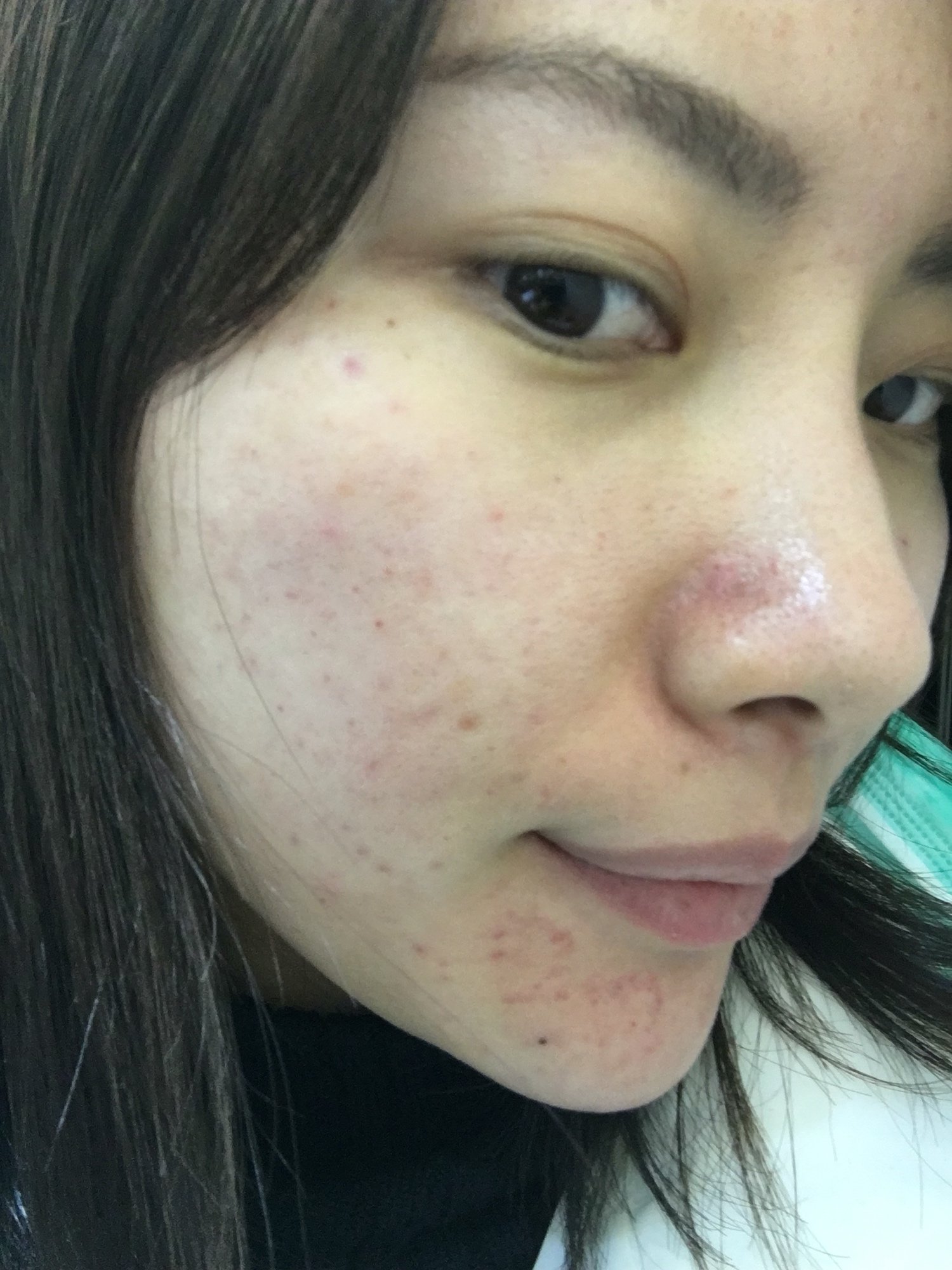 新氧- 停不下来的顾小魅 | 术后当自强 | 上海同城 | 水光针 | 激光