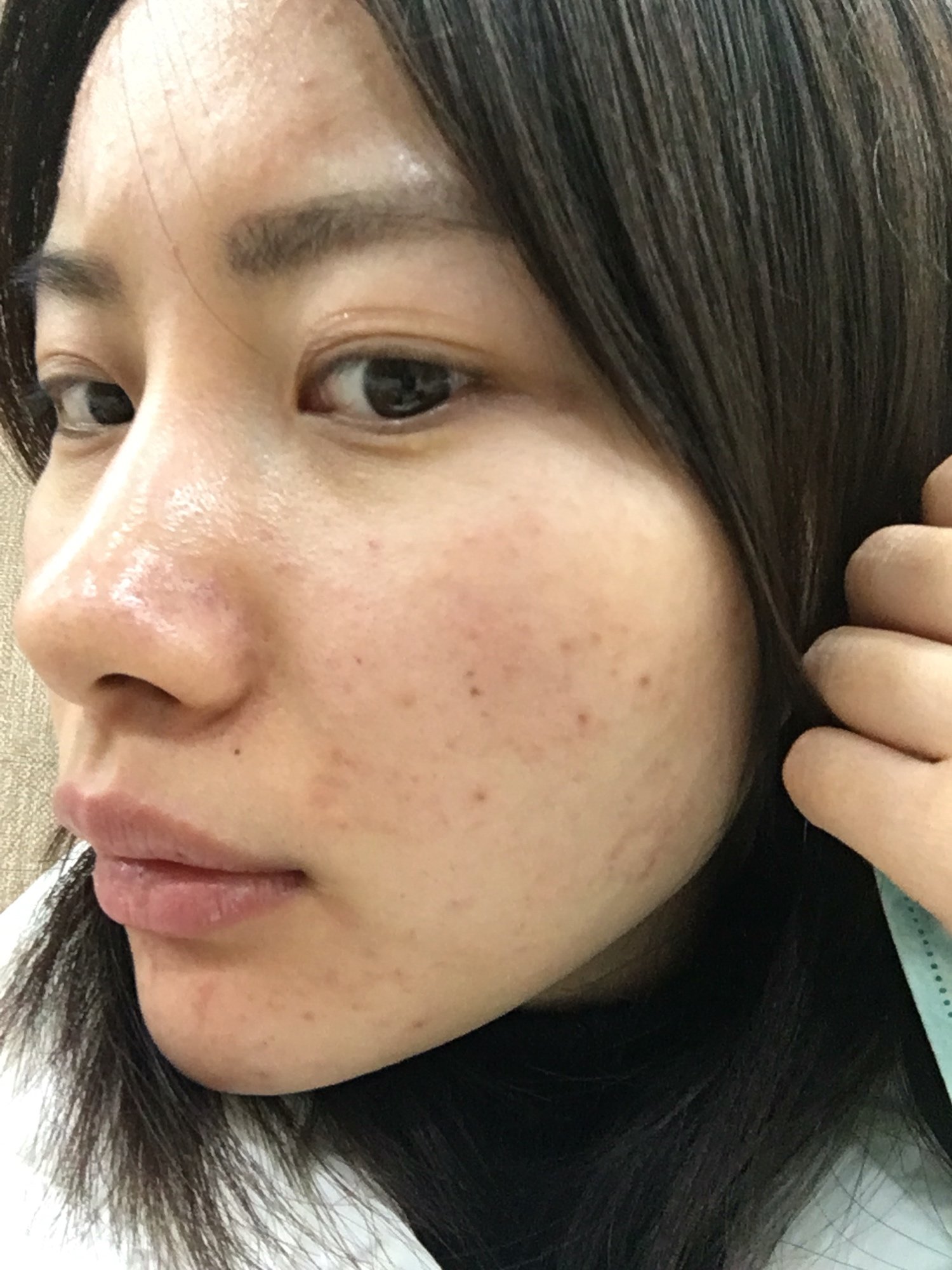 新氧- 停不下来的顾小魅 | 术后当自强 | 上海同城 | 水光针 | 激光