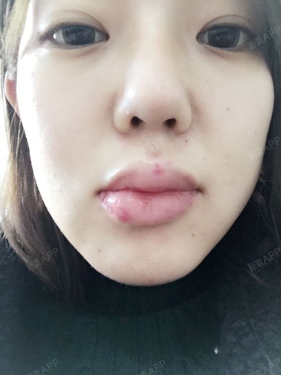 昨天刚做的玻尿酸丰唇,好痛我上嘴唇很厚,是双唇,所_圈子-新氧美容