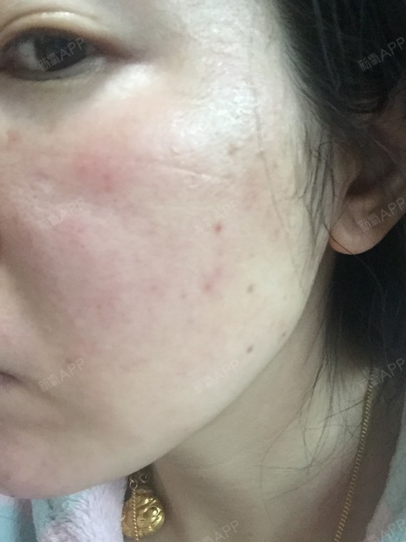 点都没有了,这三张照片是我在早上刚起来没洗脸就做完普通面膜后照的