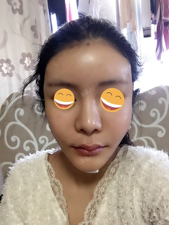 新氧- 一恩 | 面部轮廓 | 美体塑形 | 额头 | 自体脂肪填充额头